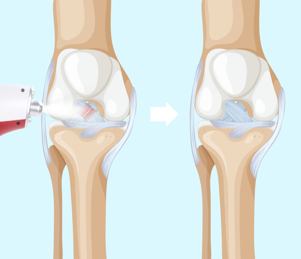 Before-and-after comparison showing CO₂ cryotherapy reducing inflammation and swelling in a patient’s bones